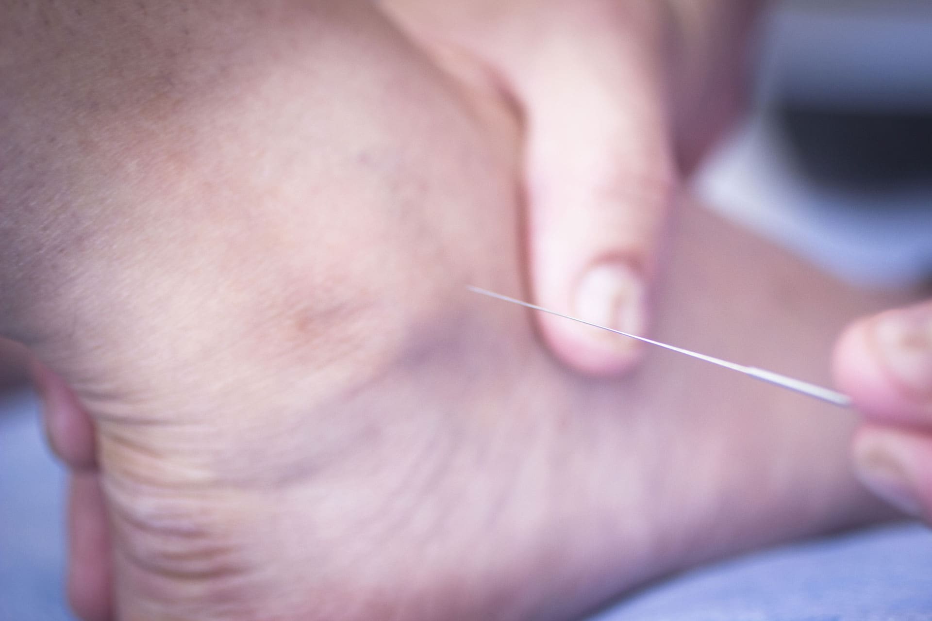 Dry needling: een dunne naald wordt in een spier van de voet gezet.