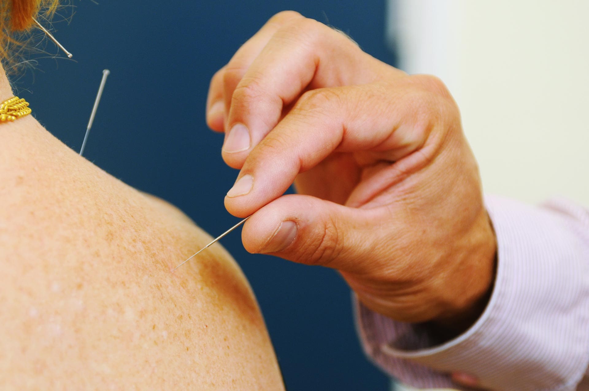 Acupuncturist zet een dunne naald in de schouder van een cliënt.